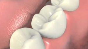 Les 3 étages d'une reconstruction unitaire sur implant dentaire